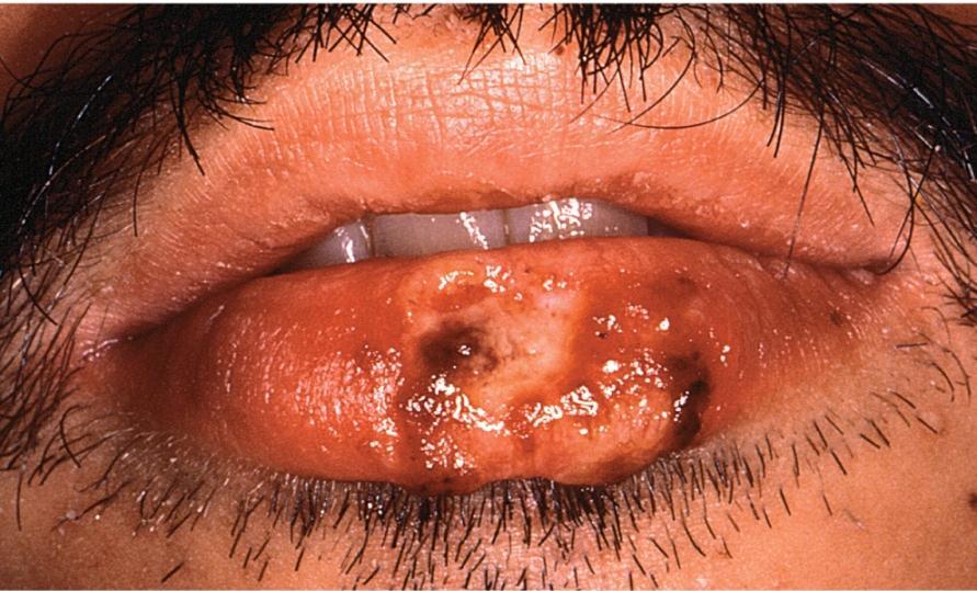 Type 1 Herpes Simplex in Children and Adults Herpes labialis fever blisters, cold sores; most common recurrent HSV-1 infection; vesicles occur on