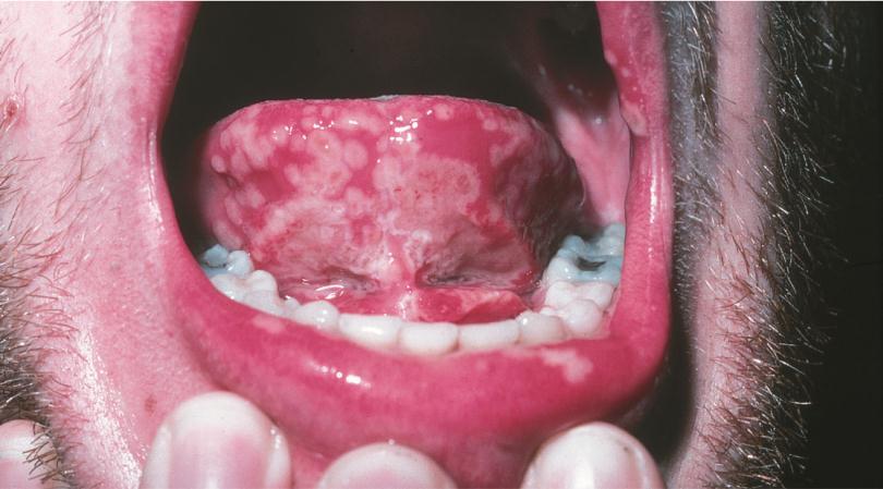 Herpetic gingivostomatitis infection of oropharynx in young children; fever, sore throat, swollen lymph nodes (b) Herpetic keratitis ocular herpes