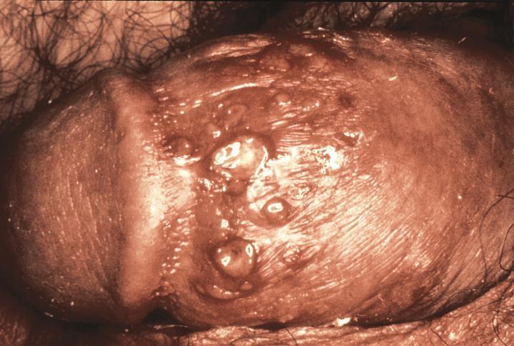 Type 2 Herpes Infections Genital herpes herpes genitalia starts with malaise, anorexia, fever, and bilateral swelling and tenderness in the groin; clusters of sensitive vesicles on the genitalia,