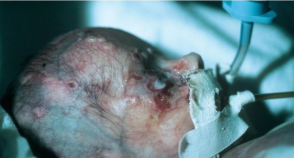 Herpes of the Newborn HSV-1 and HSV-2 Potentially fatal in the neonate and fetus Infant contaminated by mother before or during birth; hand transmission by mother to infant Infection of mouth, skin,
