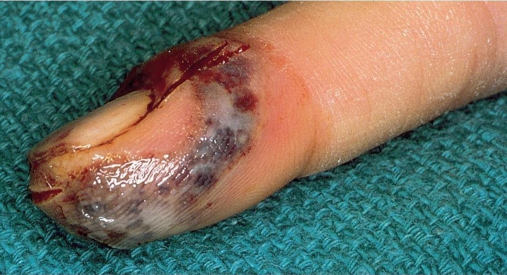 Miscellaneous Herpes Infections Herpetic whitlow : HSV-1 or HSV-2 can penetrate a break in the skin and cause a localized infection; usually on one finger; extremely painful and itchy (below) Insert