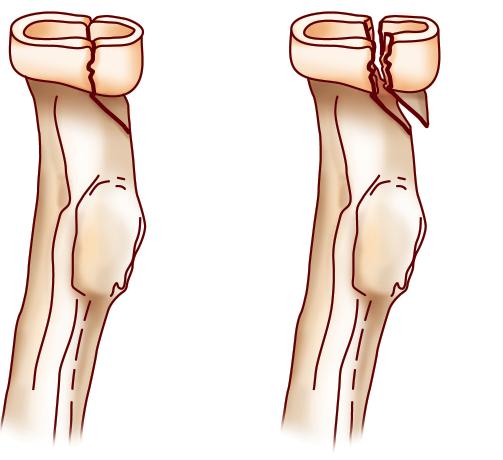 specific indications: 1 Acute Trauma Radial head fracture not suitable