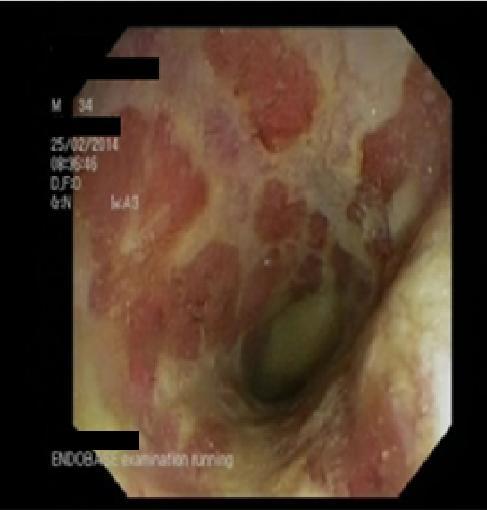 presatka protiv primatelja (engl. graft-versus-host disease, GvHD), citomegalovirusni kolitis, malignu bolest ili učinak lijekova (MMF), (Slike 6 i 7). [42] Slika 6. Terminalni ileum, Crohnova bolest.