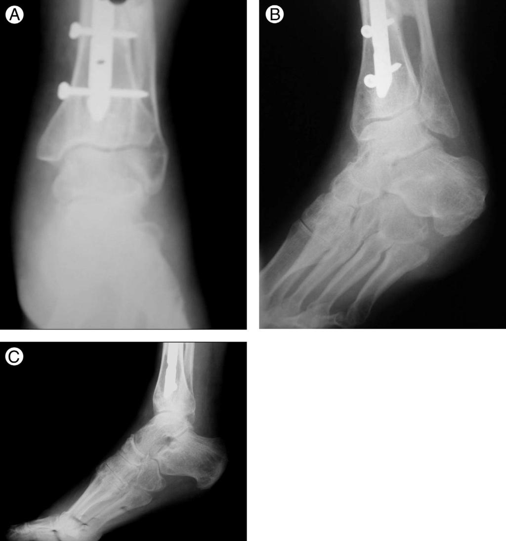 FIGURE 2 (A, B, C) Pre-operative radiographs demonstrating the fixed equinus deformity and retained tibial intramedullary rod. fracture, tibial fracture, and peroneal and tibial nerve injury.