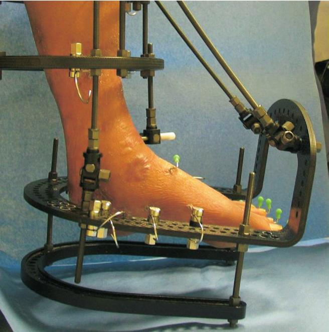 The patient underwent surgical intervention, which included application of a multiplanar circular external fixator, gastrocnemius recession, and common peroneal nerve and tarsal tunnel release.
