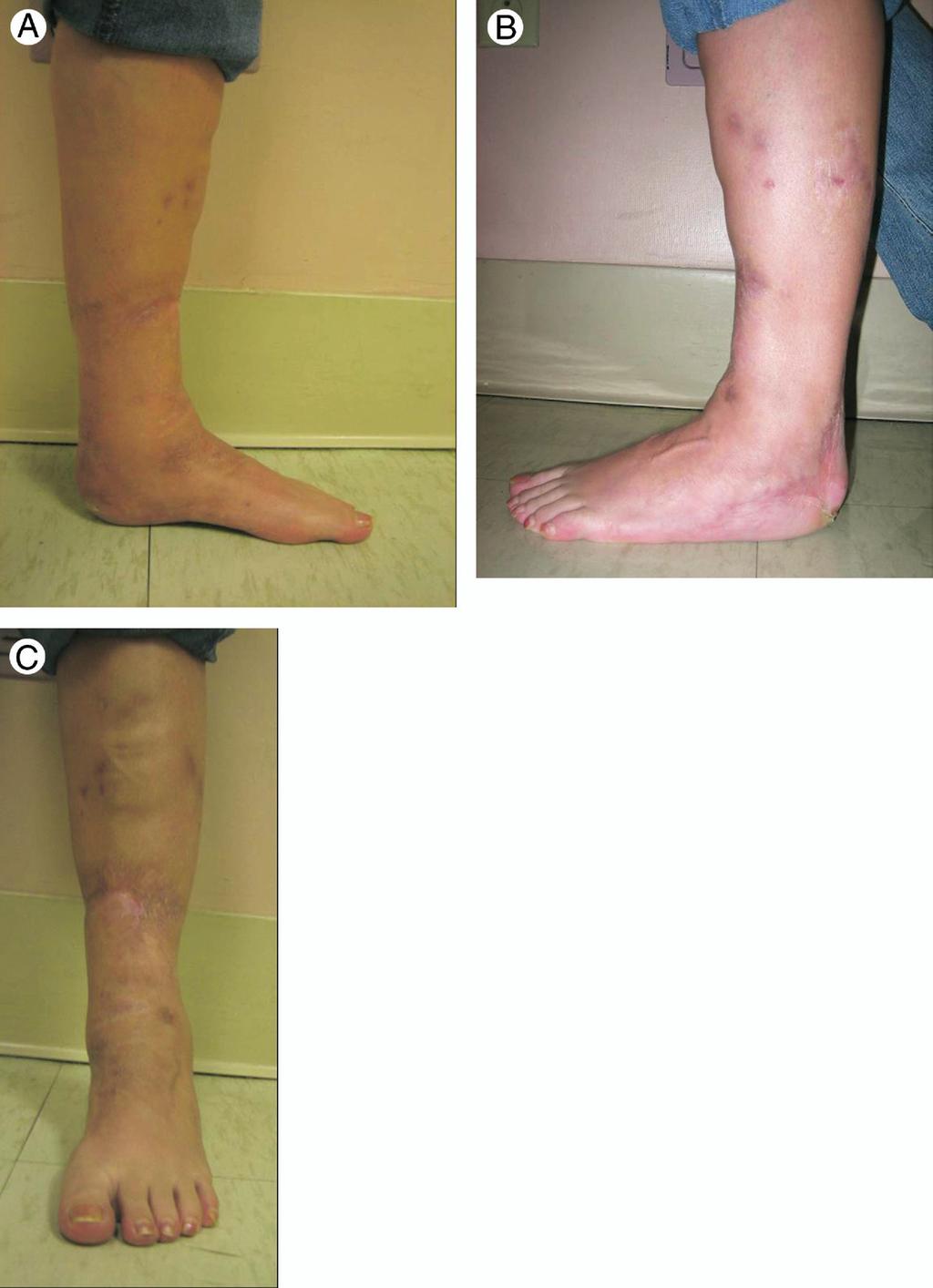 FIGURE 7 (A, B, C) Photographs of the patient at final follow-up shows the foot in