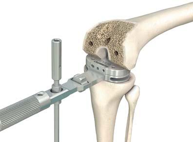 1.1 Flexion and extension gaps The fl exion gap (90 ) and extension gap (0 ) may be assessed using the modular spacer blocks.