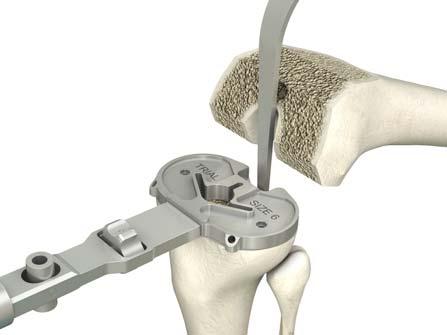 The femoral trial is used as a reference for the removal of any residual posterior condyles with the curved osteotome. This step is especially important for the posterior stabilized version. 1.