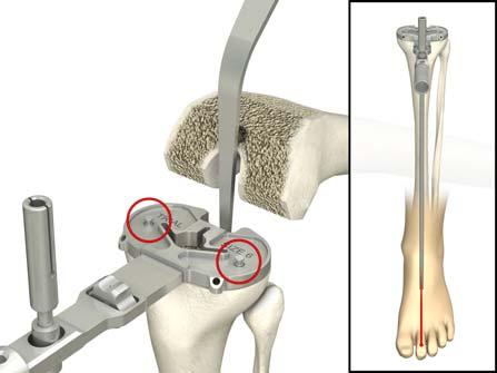 1.4 Final tibial preparation The attached tibial handle aligns with the anterior aspect of the tibia.