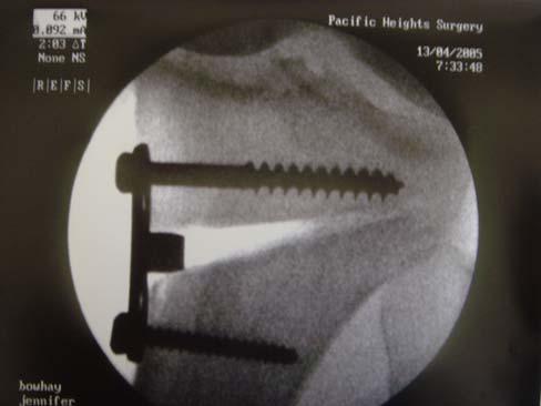 Opening Wedge Osteotomy Advantages no fib osteotomy no deformity prox tib Easier conv to TKR No added lateral laxity