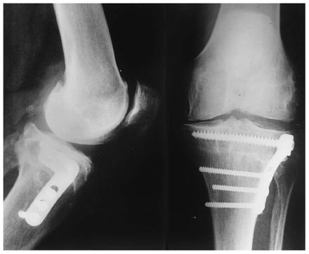 Closing Wedge Osteotomy Advantages No bone graft Earlier WB Rare non union Disadvantages Fibular