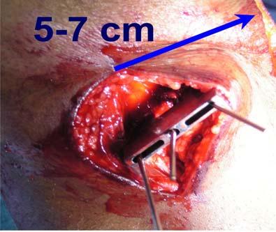 incision 5-77 cm posterior to any