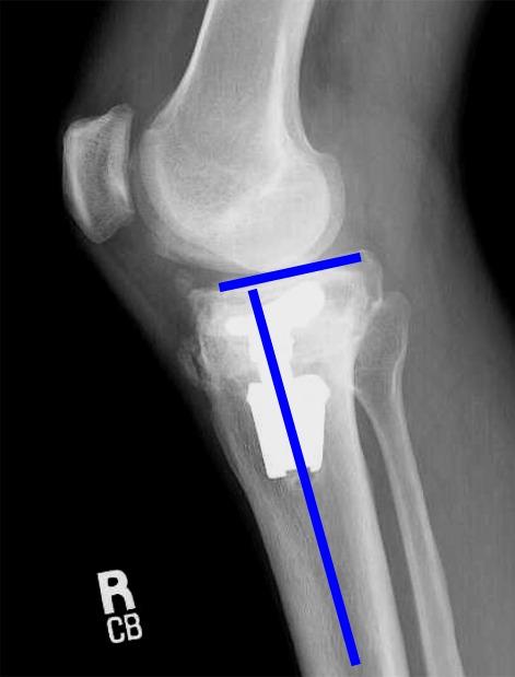 Medial Opening HTO Sagittal Plane: Tibial Slope Important to