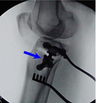 Medial Opening HTO Plate Placement and Fixation