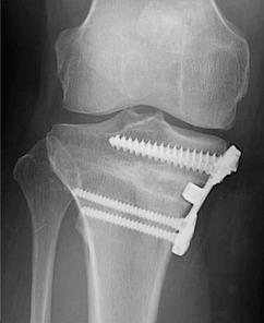 tibia on lateral view Fixation: 1 st generation: