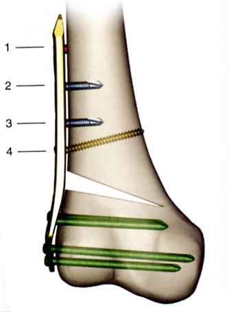 osteotomy Lateral