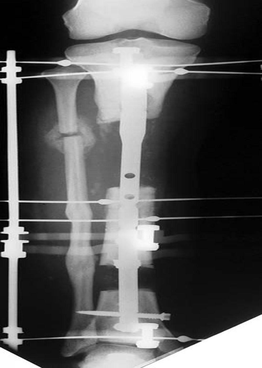 2141 Fig. 1-C Fig. 1-D Fig. 1-C A radiograph made after radical resection of the infected bone segment with débridement and placement of antibiotic beads. Fig. 1-D Bone segment distraction with a circular external fixator over an intramedullary nail.