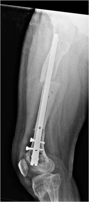The distal osteotomy corrected the