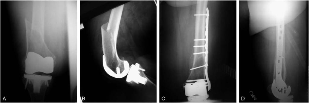 Ricci et al J Orthop Trauma Volume 20, Number 3, March 2006 RESULTS Healing Nineteen of 22 fractures (86%) healed after the index procedure after an average clinical follow-up of 12 (range, 6 40)
