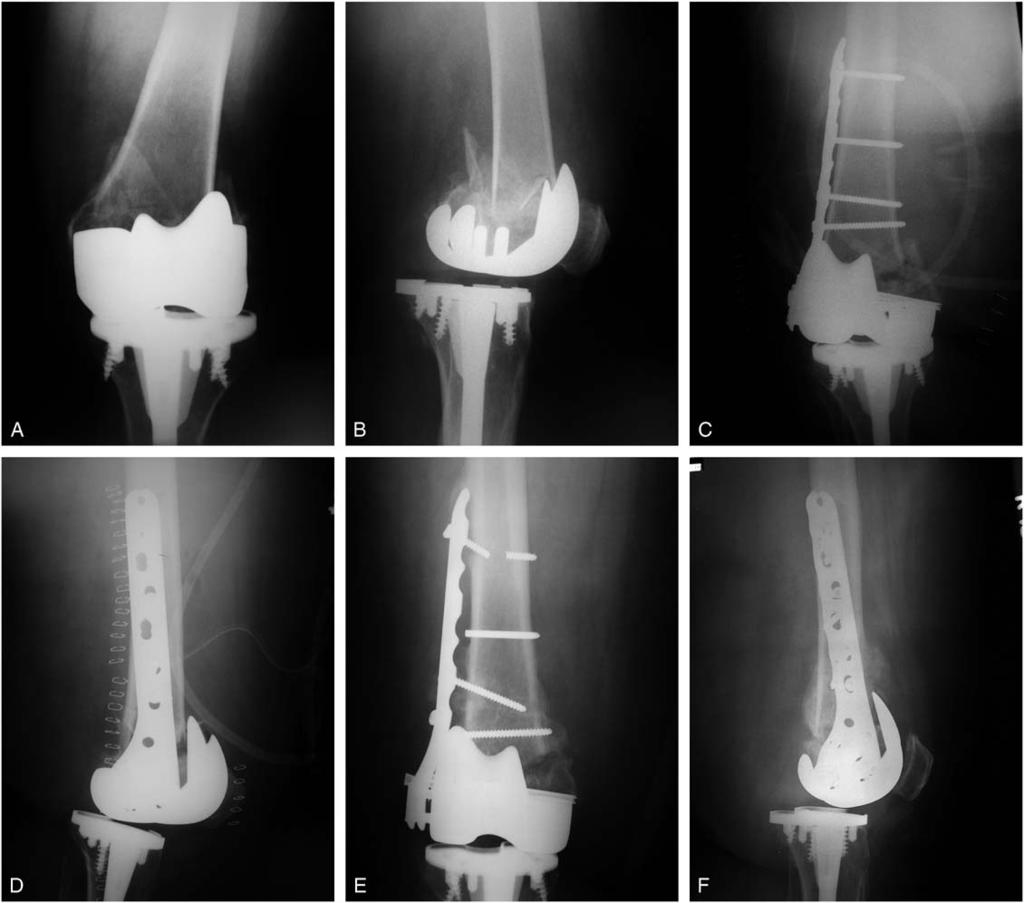 Ricci et al J Orthop Trauma Volume 20, Number 3, March 2006 FIGURE 2. Radiographs showing proximal screw failure and valgus collapse. A, Injury AP view. B, Injury lateral view.