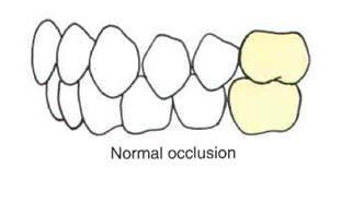 Normal Occlusion except there