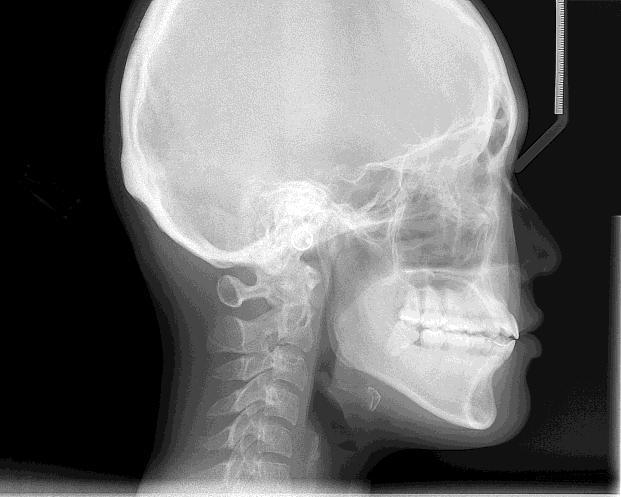 Cephalometric radiography measure the changes in tooth and jaw position produced by growth and treatment