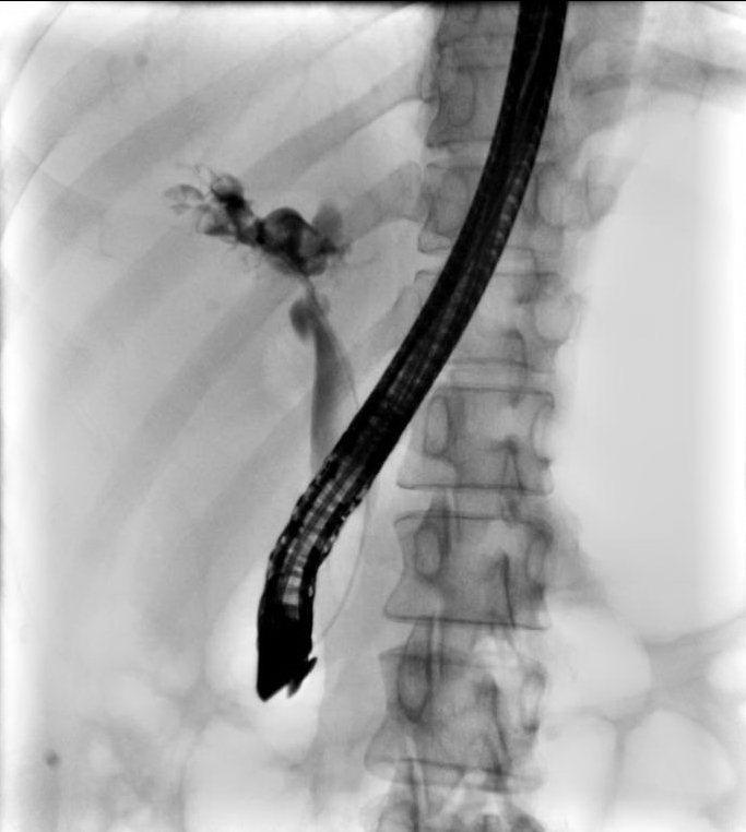 ERCP ERCP image shows diffuse intrahepatic duct