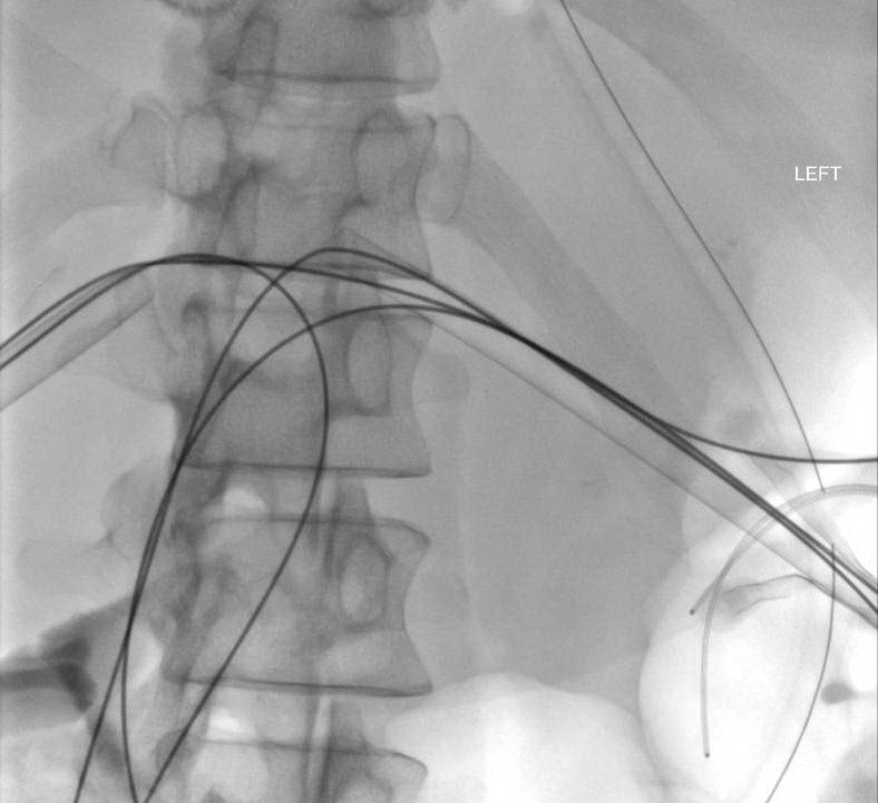 guidewires through existing biliary drainage tube tracts and