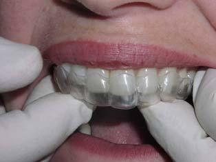 It s hard to know when and how much to do in the mouth. What makes IPR so unpredictable? When to solve?