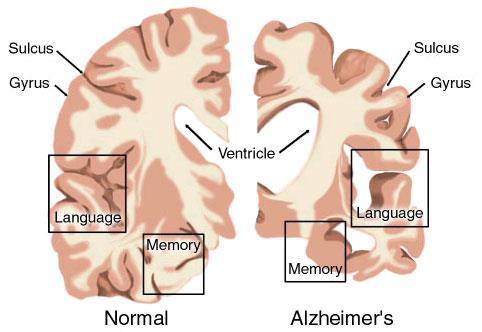 Disorders of The nervous system Degenerative brain diseases Alzheimer s Disease Progressive degeneration of neurons in the brain, eventually leading to