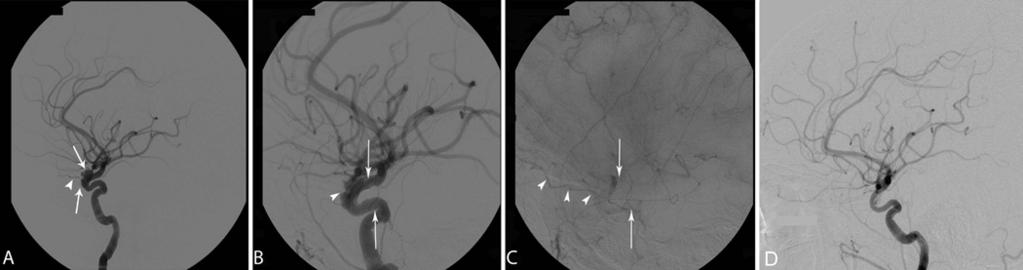 Patency of the ophthalmic artery Fig. 1. Case 3. A: Lateral DS angiogram of the right ICA in a 60-year-old woman demonstrating a complex, multilobed aneurysm (arrows) with a patent OphA (arrowhead).
