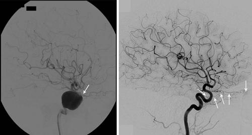 R. C. Puffer et al. Fig. 3. Case 13. Left: Angiogram of the right ICA in a 35-year-old woman demonstrating a large, cavernous-seg aneurysm and patent OphA (arrow).