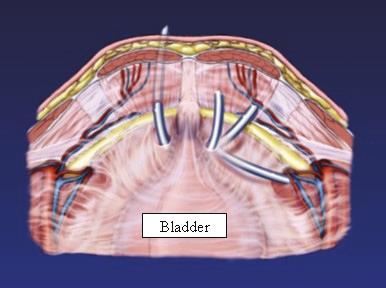 Moore, Serels & Davila Bladder Figure 5. Retropubic needle passage for tension-free vaginal tape sling. Needle on the left shows a safe retropubic passage.