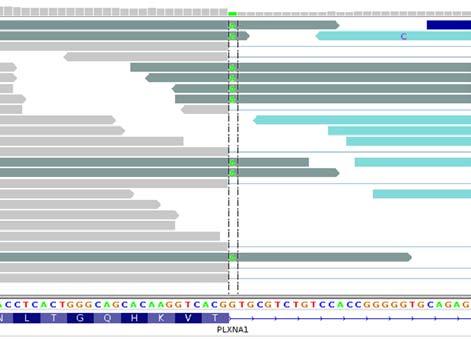 Transcriptome (RNA-Seq) ZOOMED Reads containing the +1 G>A splice site mutation show intron inclusion This