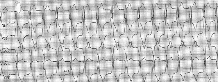 Ventricular Automaticity - Idiopathic VT Structurally normal heart Subtle