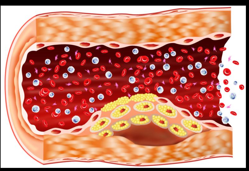 Describe two characteristics of arterioles. Explain how they work. What happens during a heart attack? What is atherosclerosis? How can you prevent it?