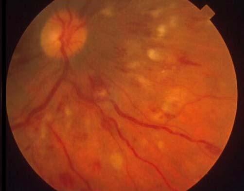 Non-Proliferative Diabetic Retinopathy Non-proliferative diabetic retinopathy (NPDR) may occur anytime after the onset of