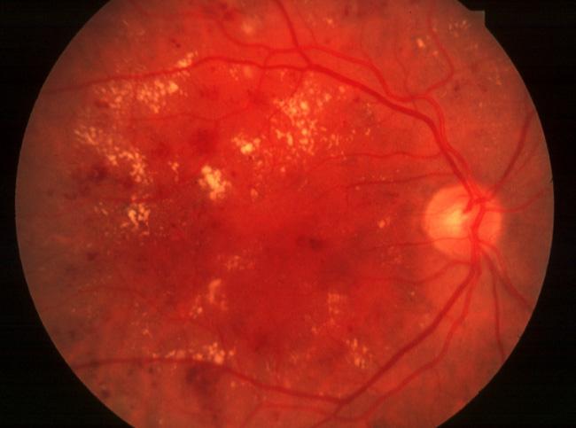 Non-Proliferative Diabetic Retinopathy When the microcirculation fails to supply the retina, there are changes