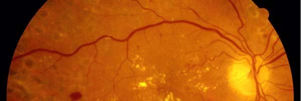 Proliferative Diabetic Retinopathy Ischaemic peripheral retina is often