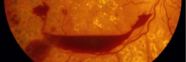 leaky and often grow around the posterior surface of the vitreous These vessels