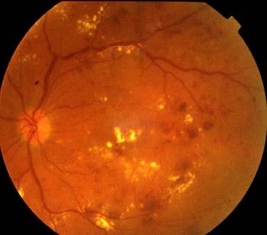 Macular Oedema Clinically significant macular oedema (CSME) is