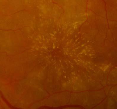 swelling of the macular related to the development of leaky