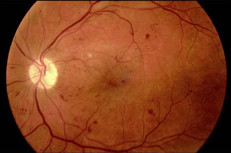 Management of NPDR Background changes are most significant when they involve the macular or surrounding retina as oedema, lipid and