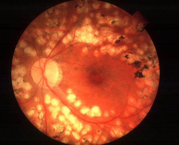 Areas of the retina away from the macula are treated
