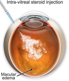 Intravitreal Therapy Recent experimental use of injecting depo