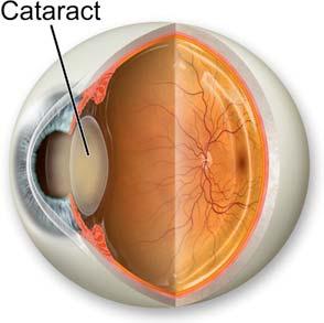 Associated Pathology Cataract development is more common in