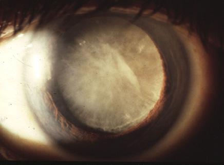 may significantly worsen the visual outcome after cataract