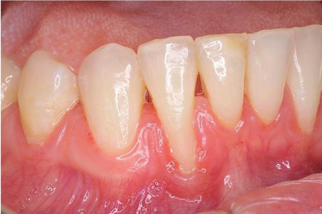 Figure 1 Type 3 Miller s defect affecting LR2 with inflammation of the gingival margin and a reduction of attached gingivae Figure 2 Recession defects affecting mandibular central incisors with