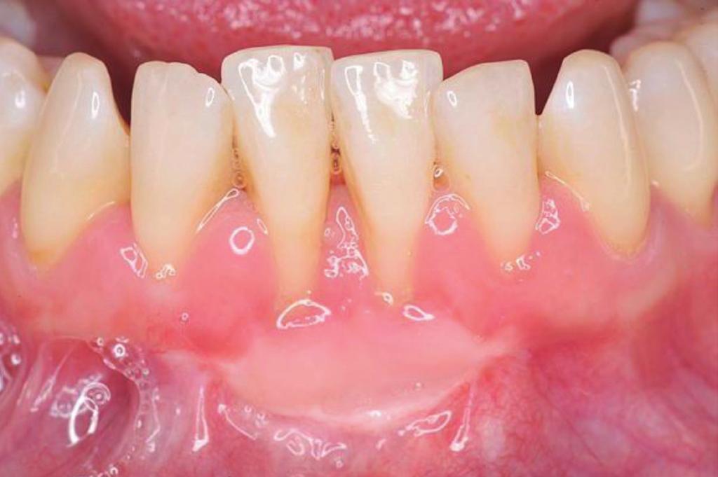 Figure 3 Twelve months following the placement of a free gingival graft in the region there is a thicker band of attached keratinized gingivae and improved oral hygiene Figure 4 showing preparation