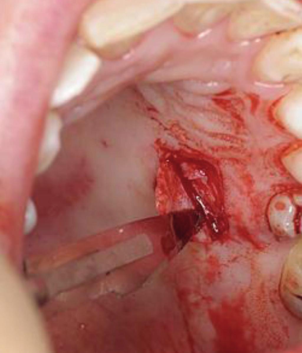 The remainder of this article will focus on the description of the free gingival graft which is particularly effective in the treatment of localised recession defects in the mandible that cannot be